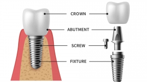 Full Mouth Dental Implants for a Confident and Natural-Looking Smile
